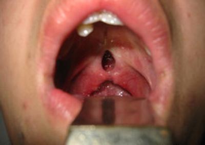Boala gurii lupului la om - trăsături, tratament, fotografie, portal, estetică