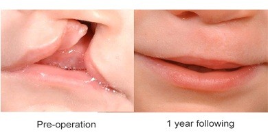 Boala gurii lupului la om - trăsături, tratament, fotografie, portal, estetică
