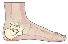 Piciorul durează din afară din lateral - cauzele și tratamentul