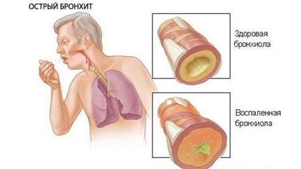 Bronchitis tünetek és a kezelés gyermekek és felnőttek részére