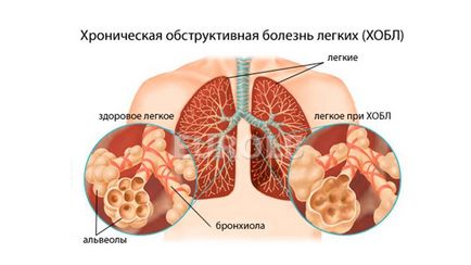 Bronchitis tünetek és a kezelés gyermekek és felnőttek részére