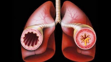 Bronchitis tünetek és a kezelés gyermekek és felnőttek részére