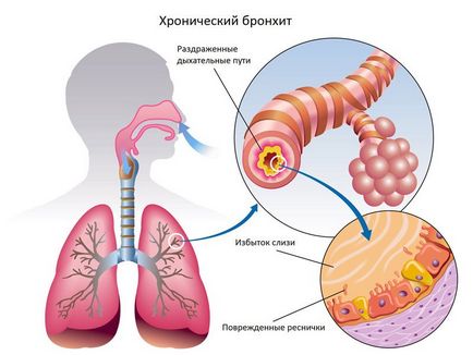 Bronchitis tünetek és a kezelés gyermekek és felnőttek részére