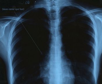 Bronchitis (tüdőgyulladás) tünetek és kezelés