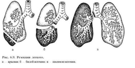 Abcesul pulmonar