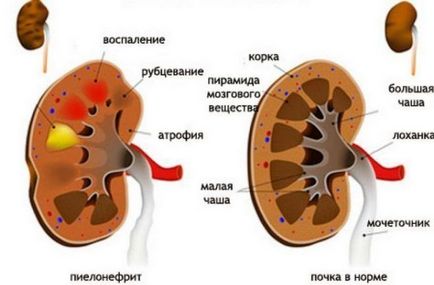 Ce trebuie făcut pentru a rezolva chistul pe rinichi