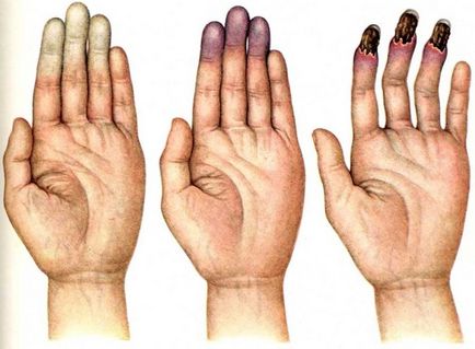 Ce trebuie făcut dacă degetul pe braț doare, inflamația pe degetul de lângă cui, pe picior sau pe braț,