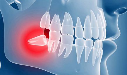 Ce trebuie să știți despre dinții de înțelepciune, 1-sănătate, superioară