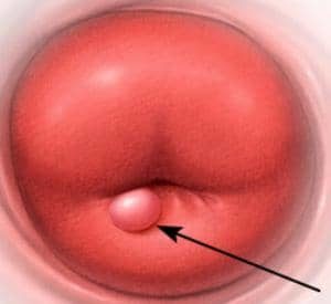 Що таке кісти ендоцервікса на шийці матки види, в чому небезпека
