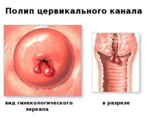 Ce sunt chisturile de endocervix pe colul speciei, care este pericolul
