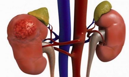 Deformarea atât a rinichilor cât și a chisurilor este ceea ce este edemul renal