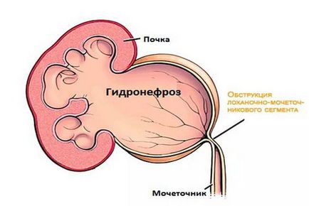 Deformarea atât a rinichilor cât și a chisurilor este ceea ce este edemul renal