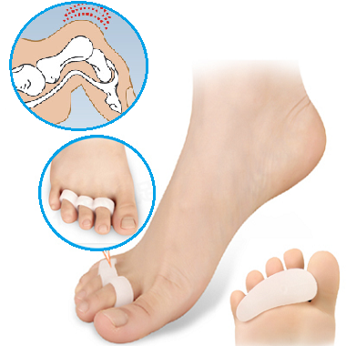 Deformarea degetelor de la picioare