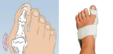 Deformarea degetelor de la picioare