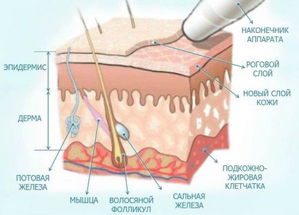 Dermabrázió bőrt a mellékhatások elkerülése érdekében