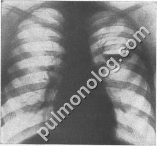 Diagnosticul diferențial al tuberculozei fibro-cavernoase și al abcesului pulmonar