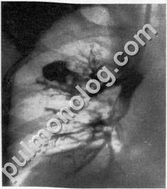 Diagnosticul diferențial al tuberculozei fibro-cavernoase și al abcesului pulmonar