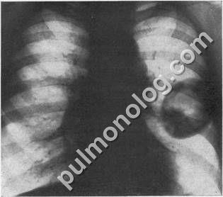 Diagnosticul diferențial al tuberculozei fibro-cavernoase și al abcesului pulmonar