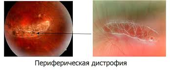 Distrofie retinală, clinică oculară a