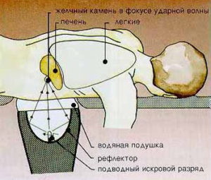 Litotripsia cu undă de șoc extracorporeală