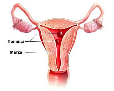 Endometriosis méh tünetek