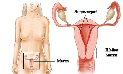 Endometrioza simptomelor uterine