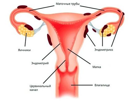 Endometriosis méh tünetek