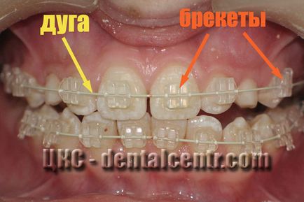 естетичні брекети