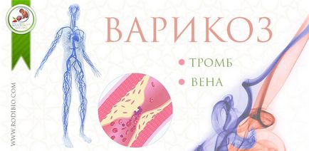 Геморой! Лікування геморою народними засобами