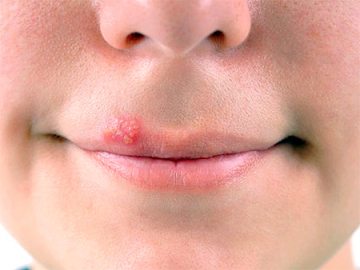 Herpes (frig) pe buze simptome, tratament, prevenire