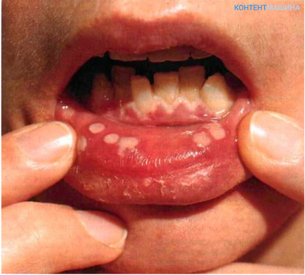 Simptome și tratament pentru stomatita herpetică la adulți