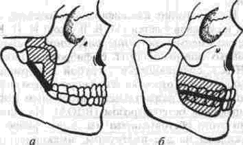 Capitolul xix contracția mandibulei și anchilozării articulațiilor temporomandibulare