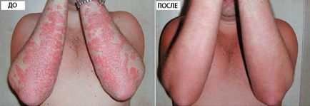 Unguentele hormonale din psoriazis, cum se aplică și care sunt contraindicațiile lor