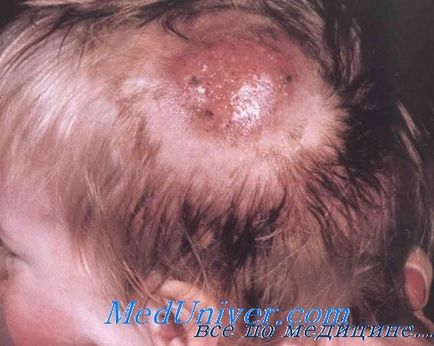 Leziunile fungice ale scalpului - diagnostic, tratament (fungice) Leziunile fungice ale scalpului - diagnostic, tratament