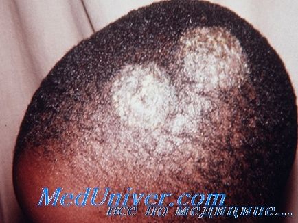 Leziunile fungice ale scalpului - diagnostic, tratament (leziuni) Leziunile fungice ale scalpului - diagnostic, tratament