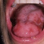 A gomba a szájban, a gyermek, a mandulák és a torok kezelésére