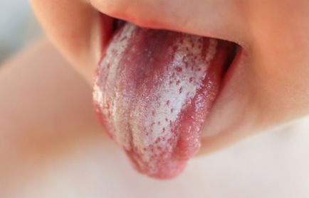 Грибок в роті у дитини, на мигдалинах або в горлі лікування