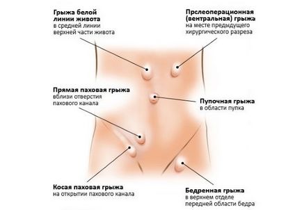 Hernia clasificare, cauze, simptome, tratament