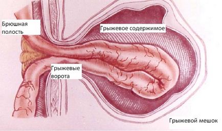 Грижа класифікація, причини, симптоми, лікування