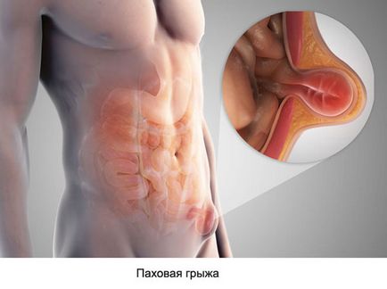 Hernia clasificare, cauze, simptome, tratament