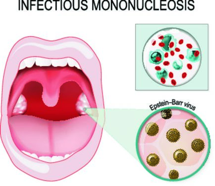 Mononucleoza infecțioasă - tratament