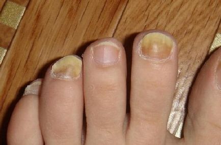 Як швидко вилікувати грибок нігтів