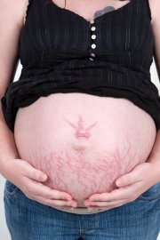 Як боротися з розтяжками після вагітності