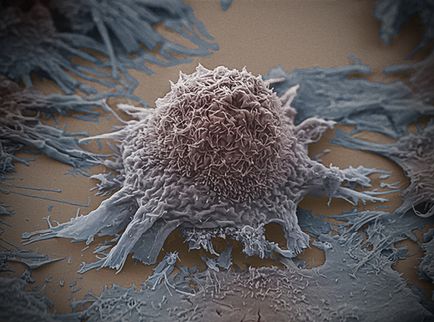 Cum de a trata cancerul cu remedii folclorice