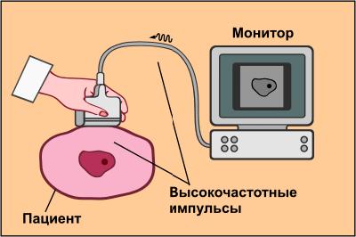 Hogy az ultrahangos érzékelő