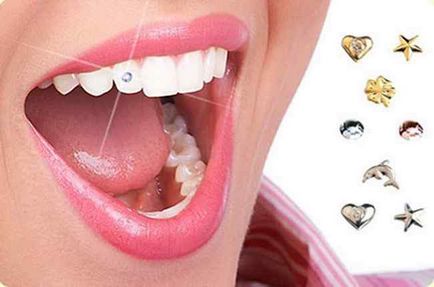 Як встановлюють скайси на зуби