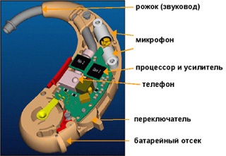 Як влаштований слуховий апарат