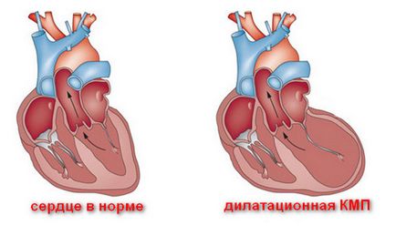 Cardiomiopatia ce este, specii decât periculoase, previziuni