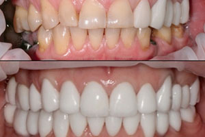 Керамічна коронка на передні зуби ціна, фото до і після
