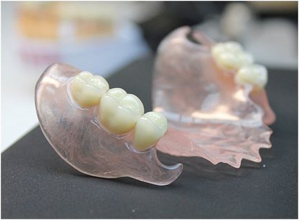 Керамічна коронка на передні зуби ціна, фото до і після